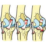 PCL Tear Grades 1-3