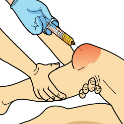 PCL Cortisone Treatment