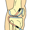 PCL Reconstruction