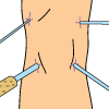 Arthroscopic Procedure