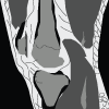 PCL Tear MRI